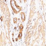 Formalin-fixed, paraffin embedded leiomyosarcoma sections stained with 100 ul anti-Actin, Smooth Muscle (clone SPM332) at 1:100. HIER epitope retrieval prior to staining was performed in 10mM Citrate, pH 6.0.